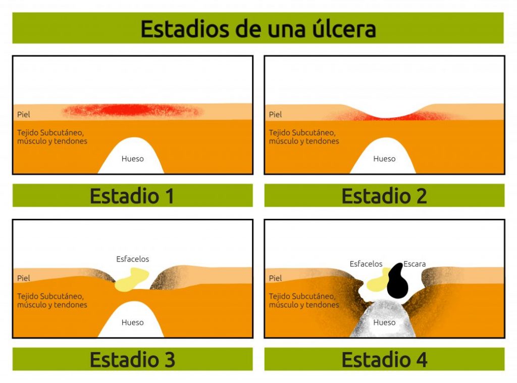 Ilustración que muestra los diferentes estadios de las úlceras por presión.