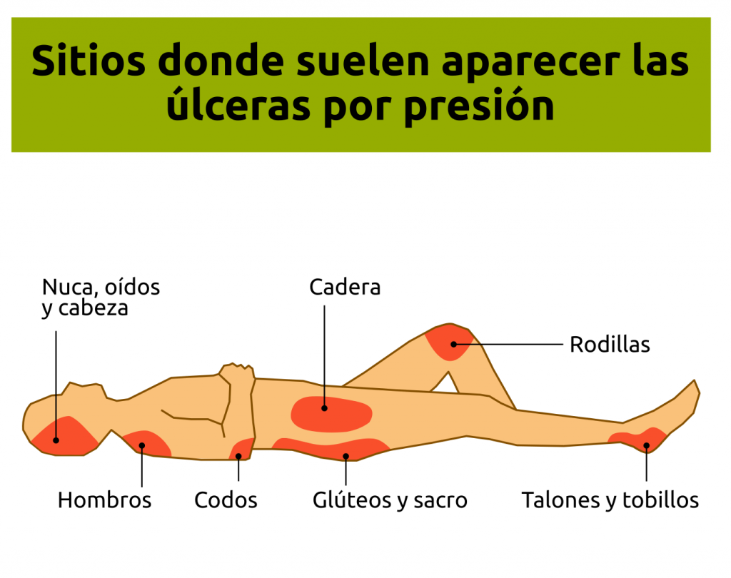 Las protuberancias óseas son los sitios más comunes donde aparecen las úlceras por presión.