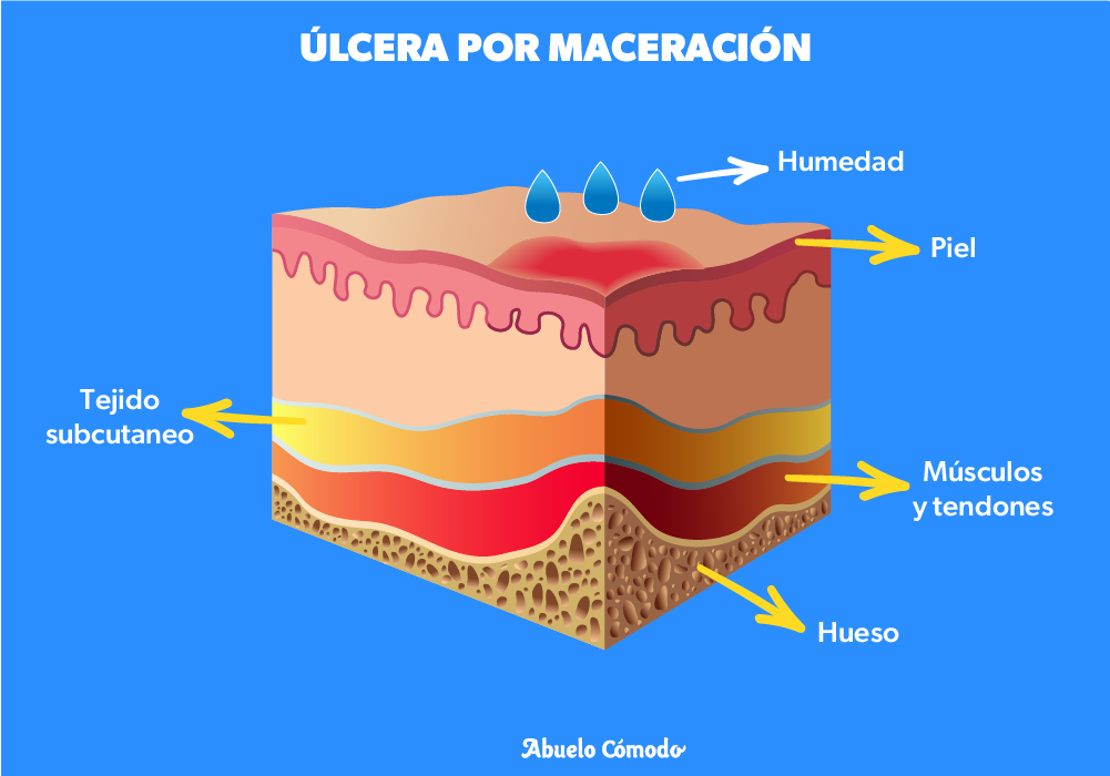 Principales factores físicos que causan úlceras por presión. Cuidado de adulto mayor. cuidado de ancianos. cuidando  mi abuelito. como evitar ulceras. como se producen las ulceras. ulcera por presion. ulcera por maceracion.