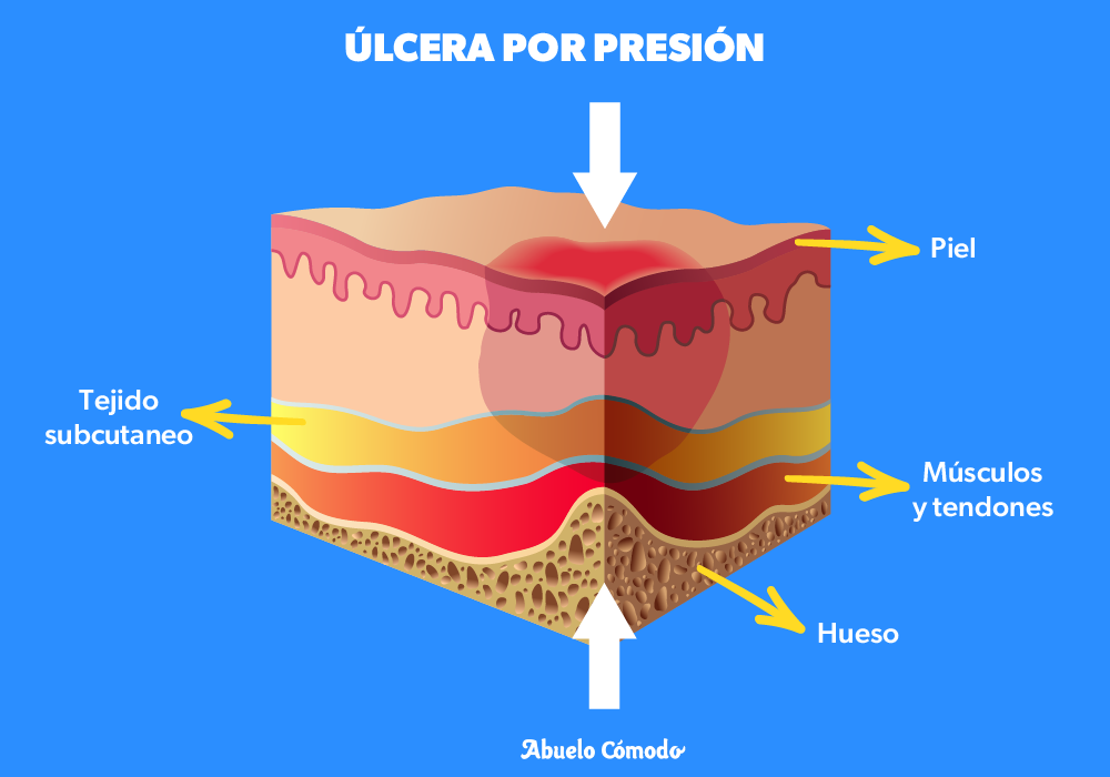 Donde Aparecen Las lceras Por Presion UIEB Donde Aparecen Las lceras Por Presion UIEB