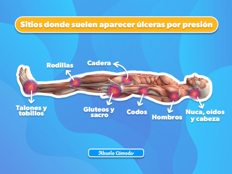 Úlceras por presión o escaras: así se ven sus 4 etapas